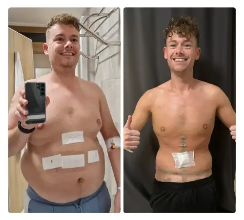Before After-20