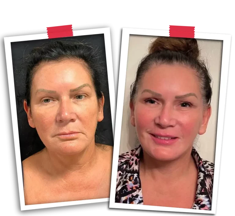 Facial Rejuvenation