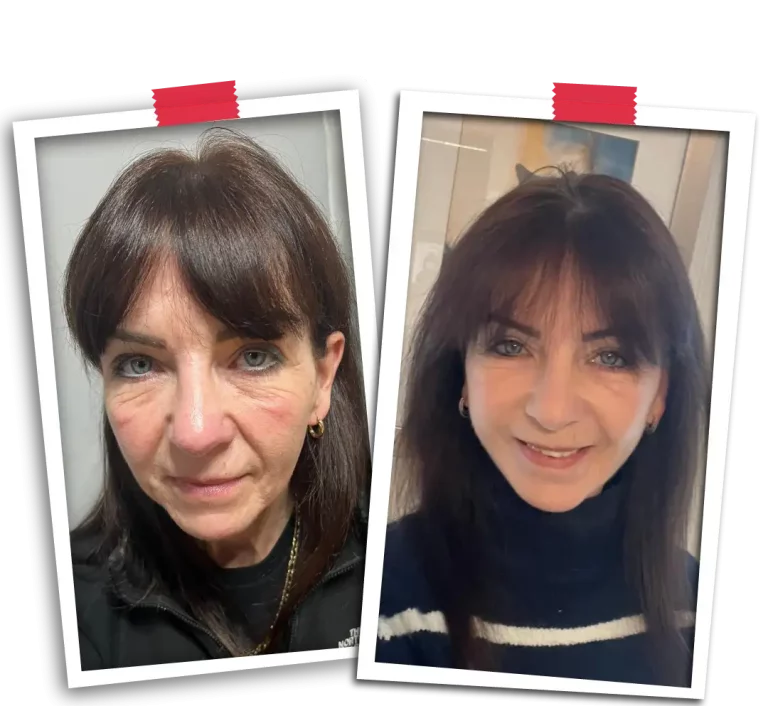 Facial Rejuvenation