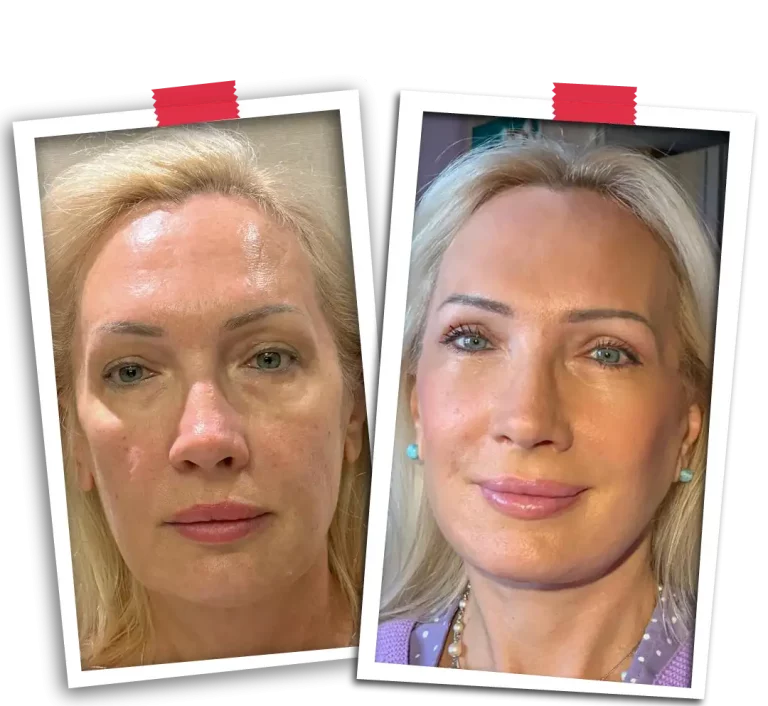 Facial Rejuvenation