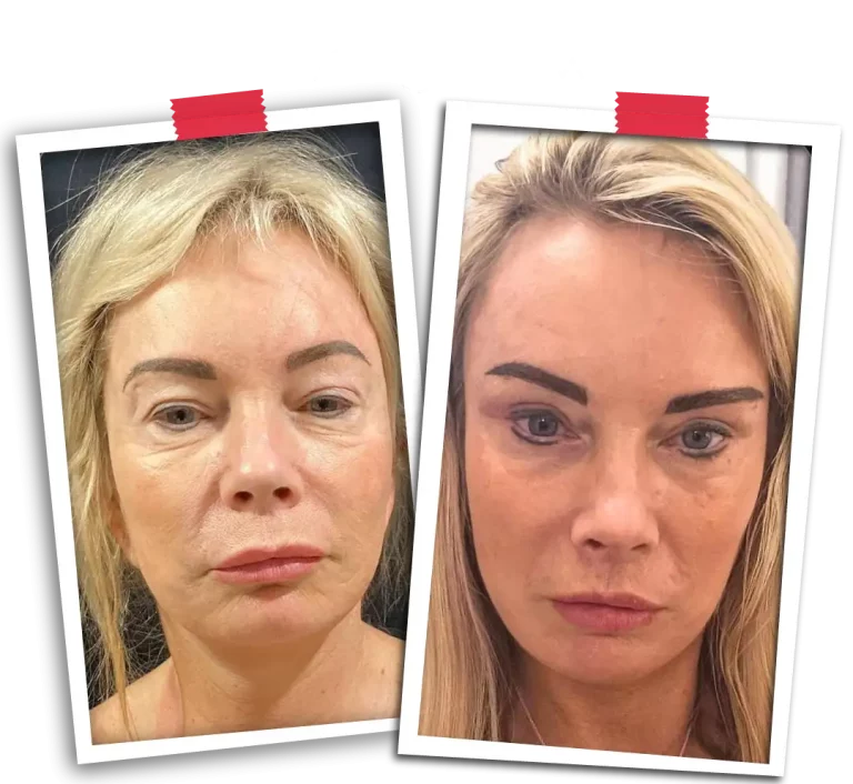 Facial Rejuvenation