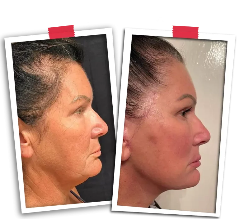 Facial Rejuvenation