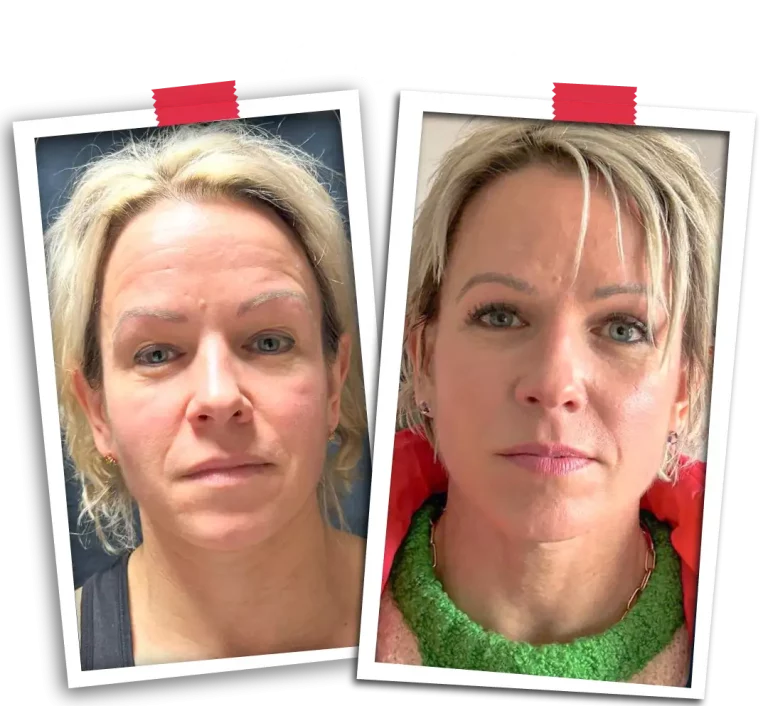 Facial Rejuvenation