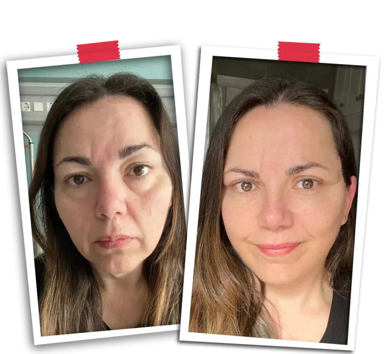 Facial Rejuvenation