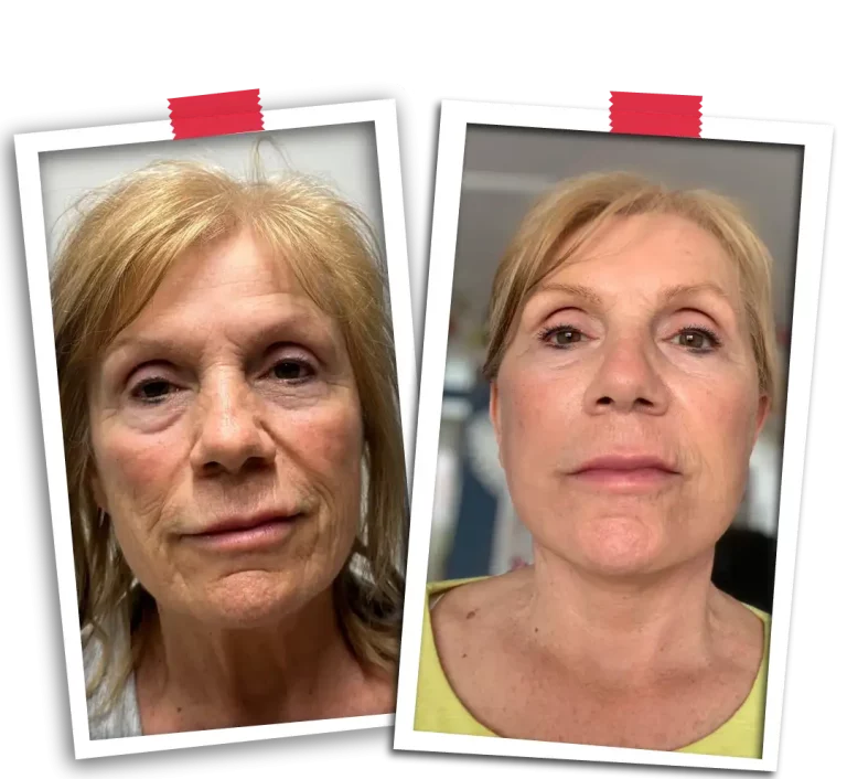 Facial Rejuvenation