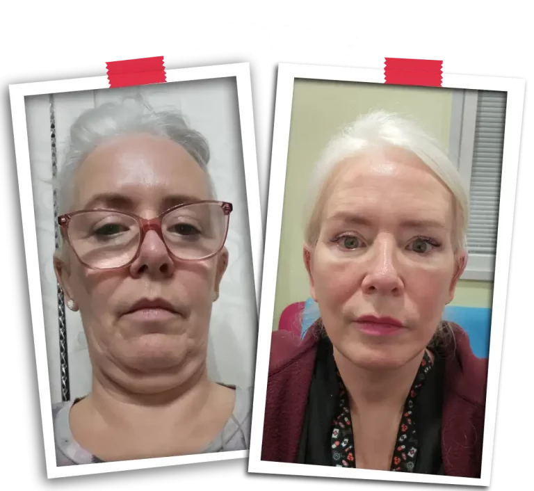 Facial Rejuvenation