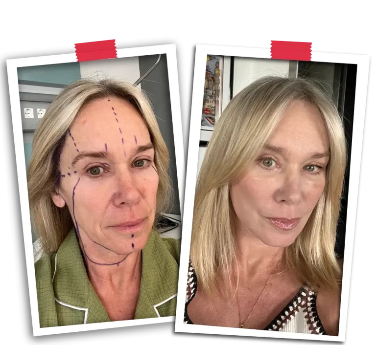 Facial Rejuvenation