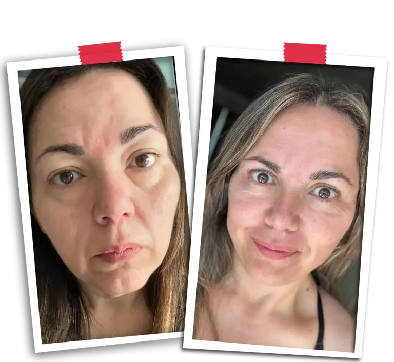 Facial Rejuvenation