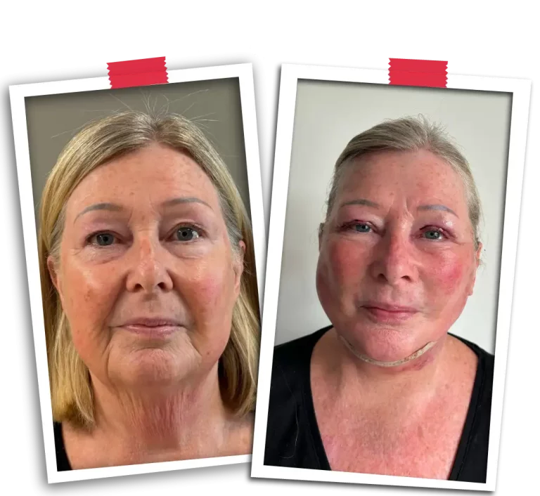 Facial Rejuvenation