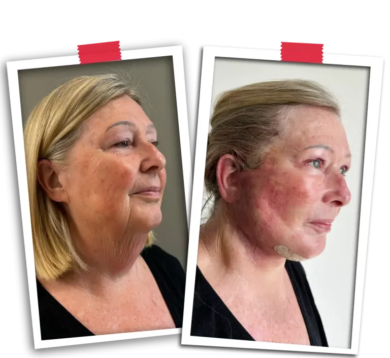 Facial Rejuvenation