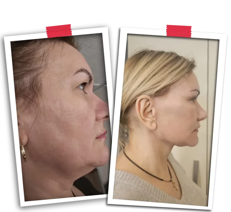 Facial Rejuvenation