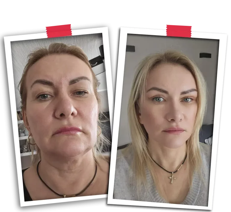 Facial Rejuvenation