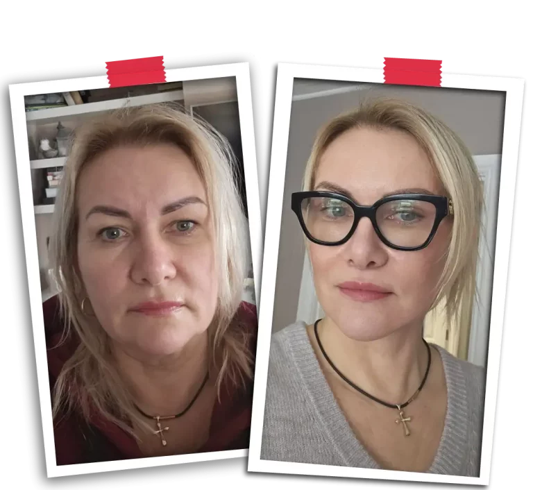 Facial Rejuvenation