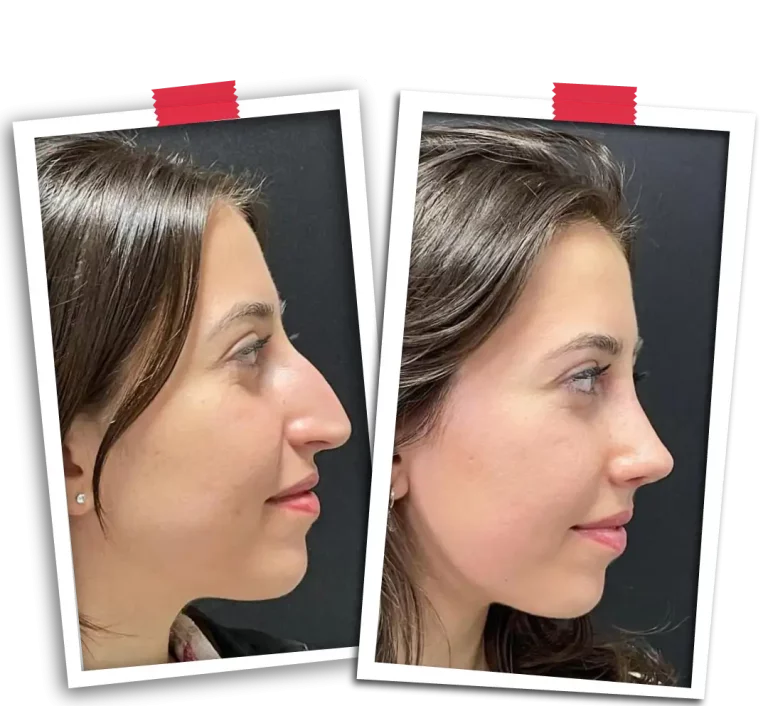 Rinoplasti Before After VP-07