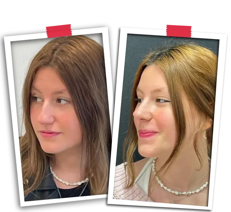 Rinoplasti Before After-21