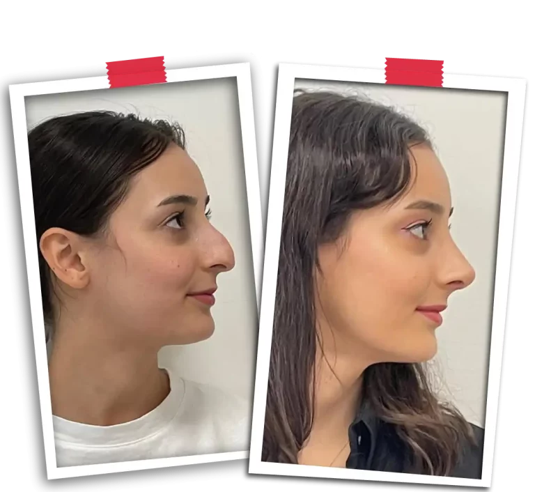 Rinoplasti Before After-24