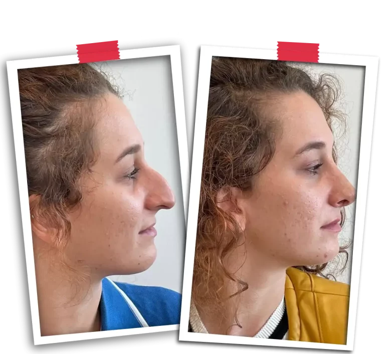 Rinoplasti Before After-28