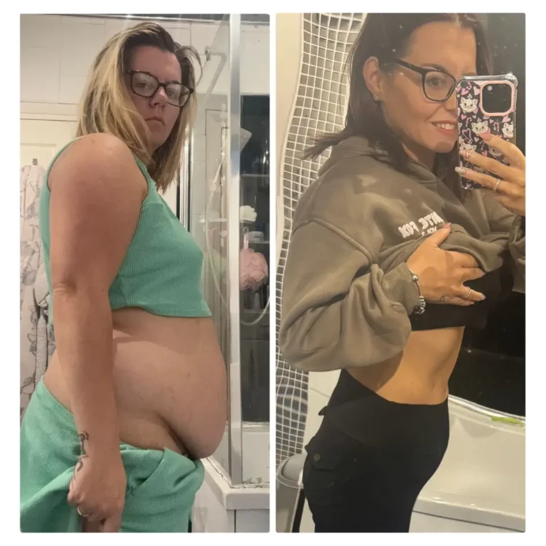 Before After Bariatric EN-01