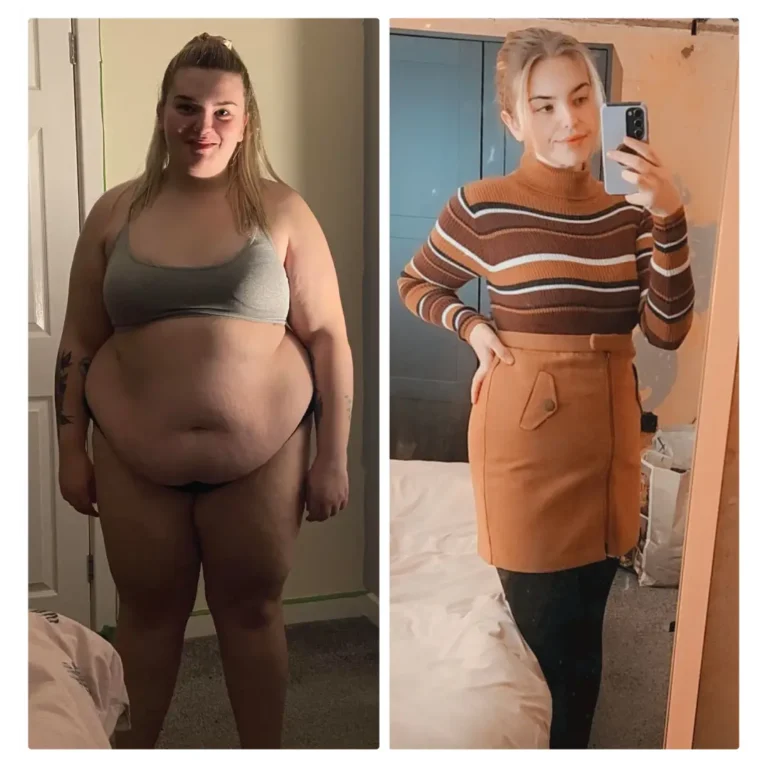 Before After Bariatric EN-02