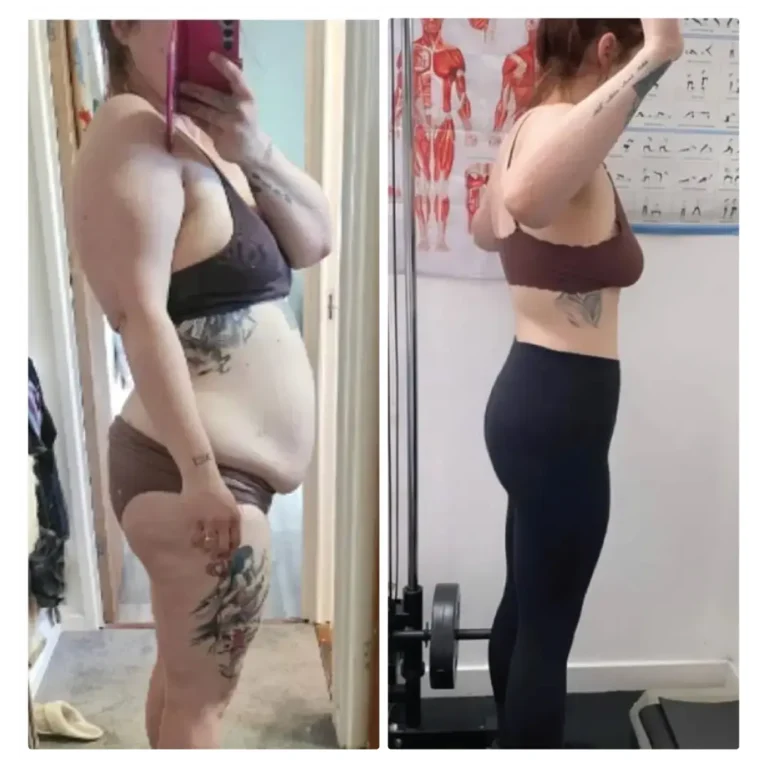 Before After Bariatric EN-05