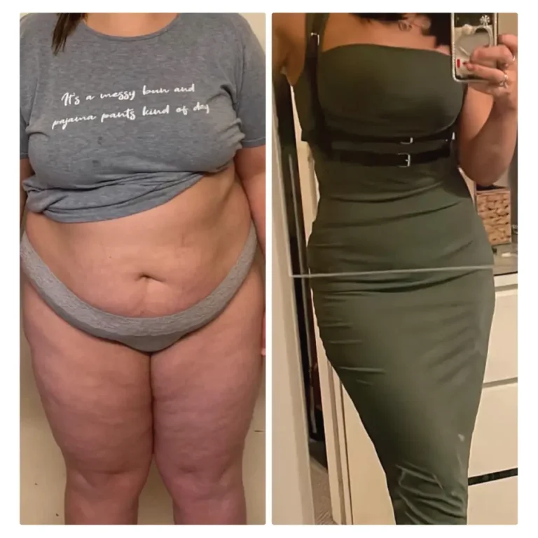 Before After Bariatric EN-06