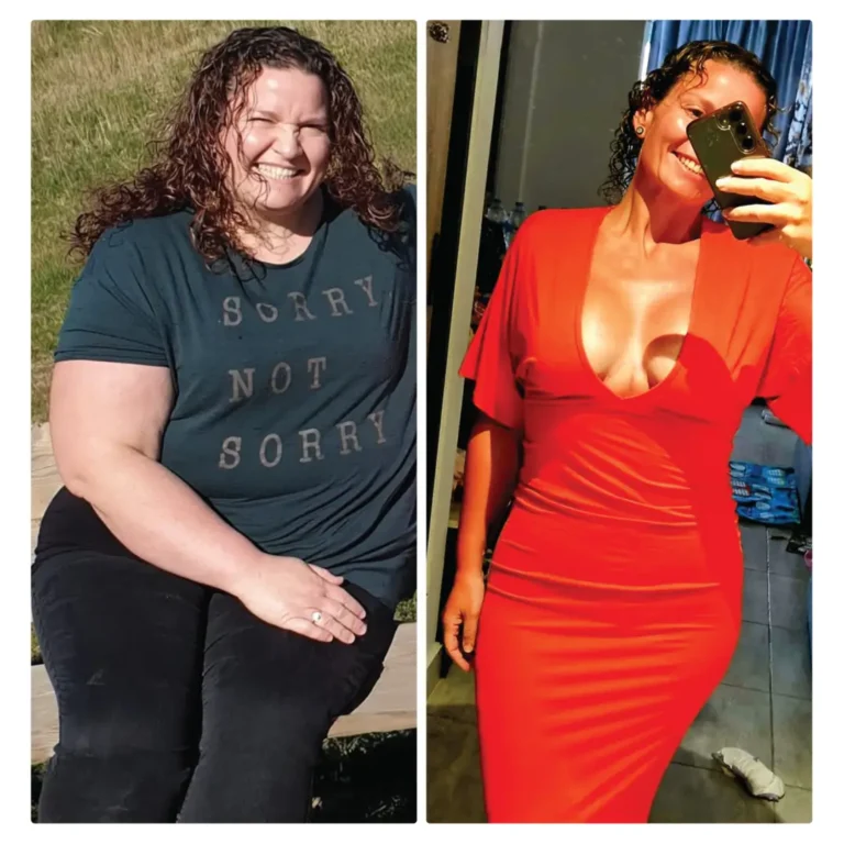 Before After Bariatric EN-08