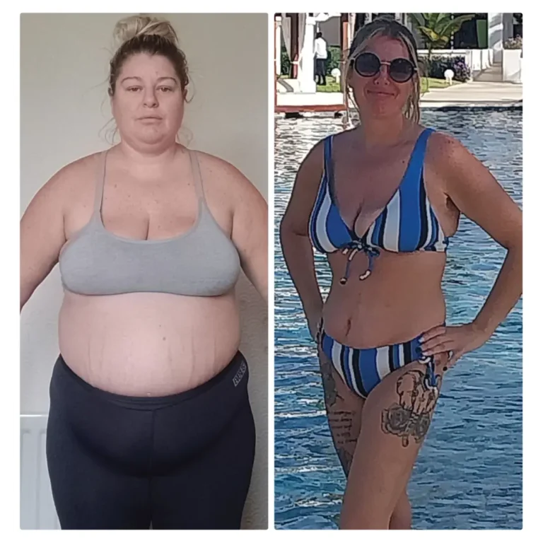 Before After Bariatric EN-17