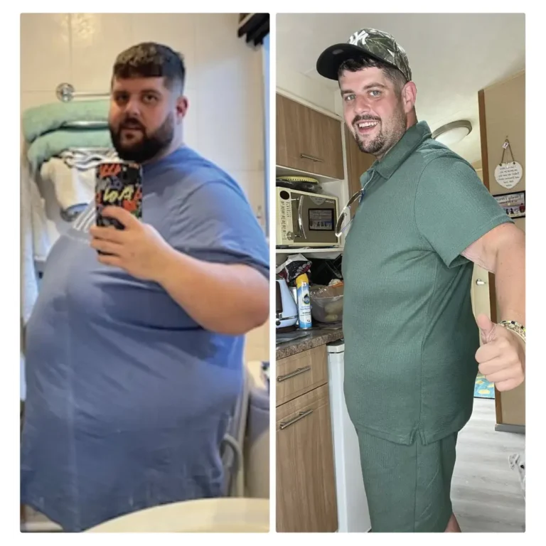 Before After Bariatric EN-18