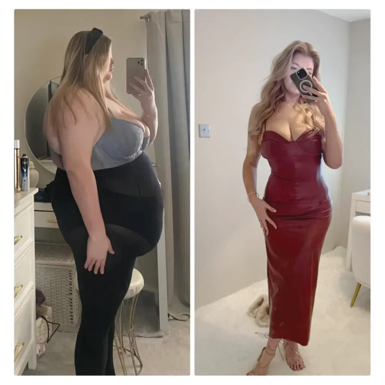 Before After Bariatric EN-22