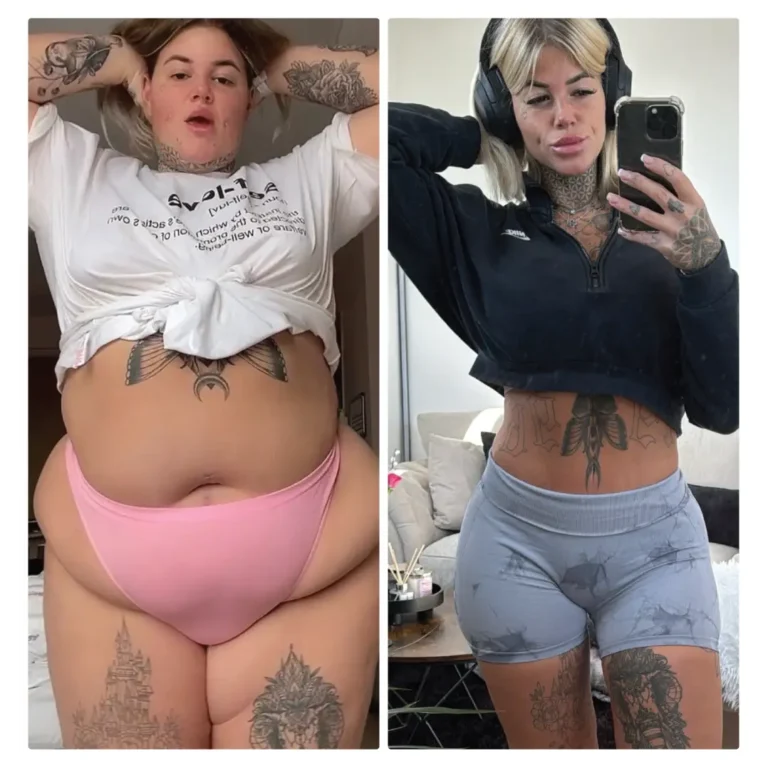 Before After Bariatric EN-23