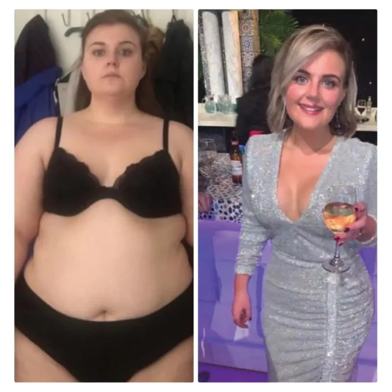 Before After Bariatric EN-24