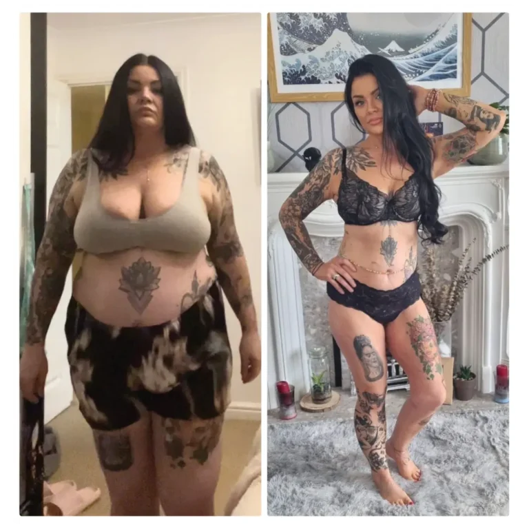 Before After Bariatric EN-25