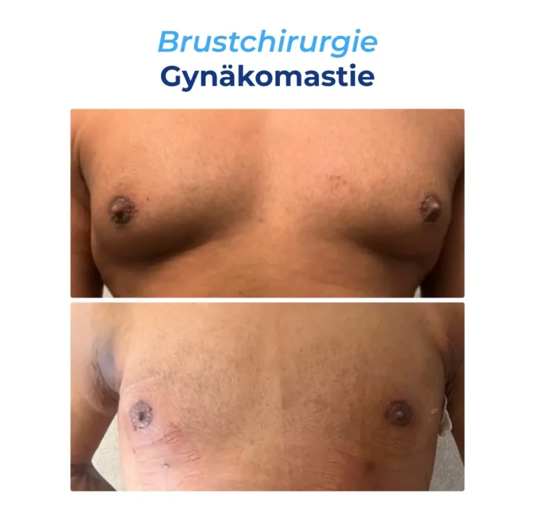 Before After DE-06