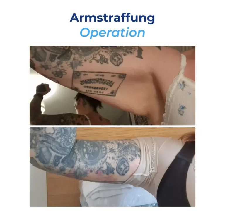 Before After DE-24