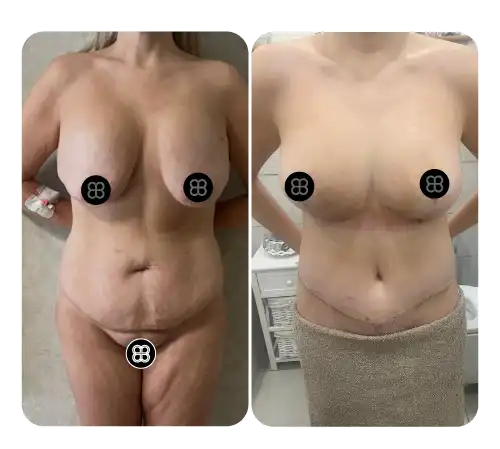 Breast-01