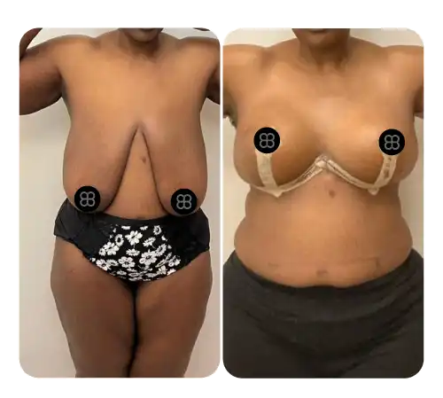 Breast-14