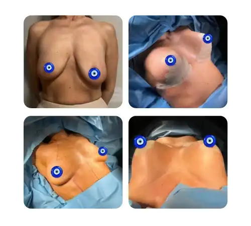 Breast-15