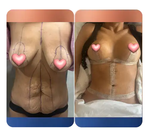 Breast-20