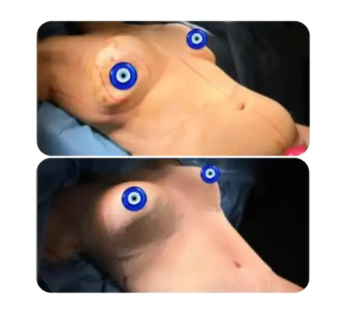 Breast-21