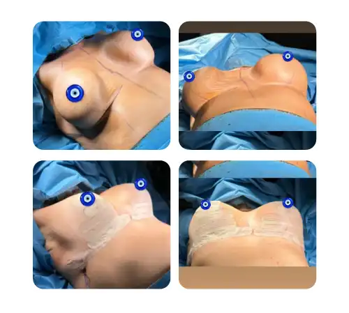 Breast-22