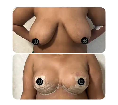 Breast-25