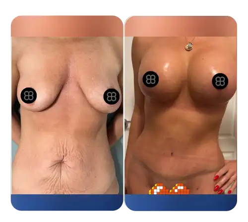Breast-27
